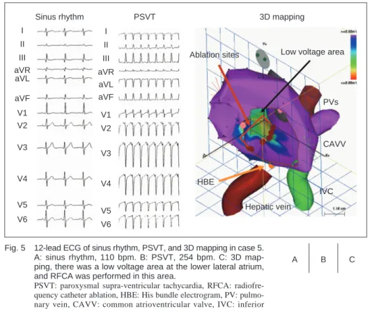 Fig. 5  12-lead ECG of sinus rhythm, PSVT, and 3D mapping in case 5.