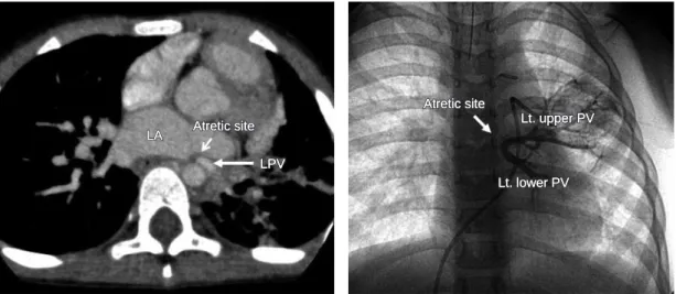 Fig. 1b: Preoperative left pulmonary wedged arteriography. 
