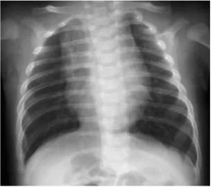 Fig. 1  Chest roentgenogram dem- dem-onstrating mesocardia, and  hyperinfl ation of the lungs.
