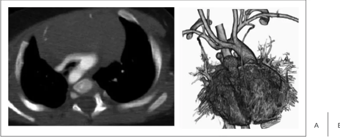 Fig. 4 Angiogram demonstrating cTGA {S,L,L}, left aortic arch and right descending aorta.