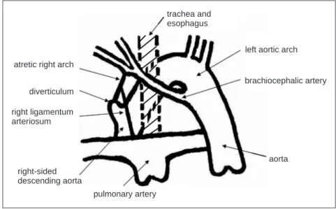 Fig. 5  Schematic illustration of the vascular ring.
