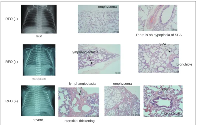 Fig. 4  Chest X-ray and histologic fi ndings.