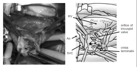 Fig. 3  Pre- and postoperative recordings of the Holter ECG. 