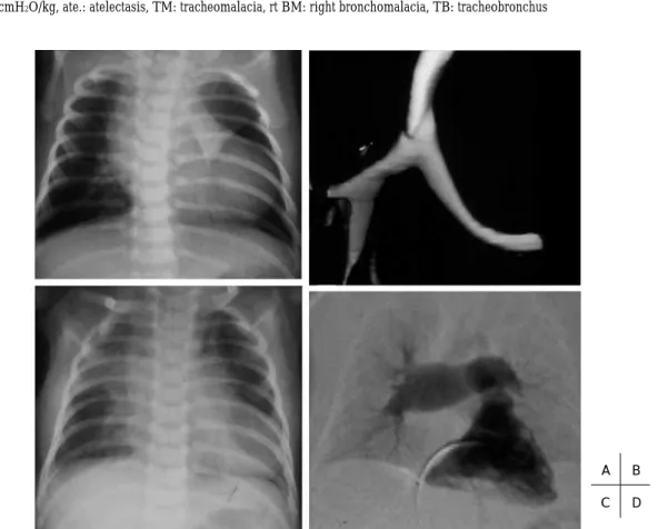 Table 1 Characteristics of three patients Fig. 1 Case 1  Chest X-P showed pulmonary hyperinflation and atelectasis of the left lung at admis- sion (A) and progressive extension of atelectasis within a month (C). Preoperative 3-DCT demonstrated tracheobronc