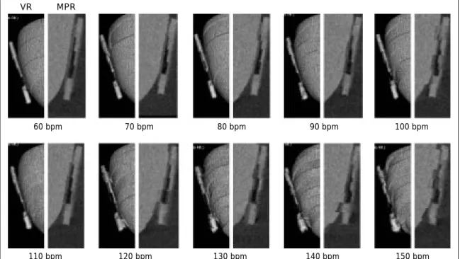 Fig. 2 Selection of reconstruction algorithms [simulated coronary artery (5 mm)]: Cardiac half reconstruction (CHR) algorithm
