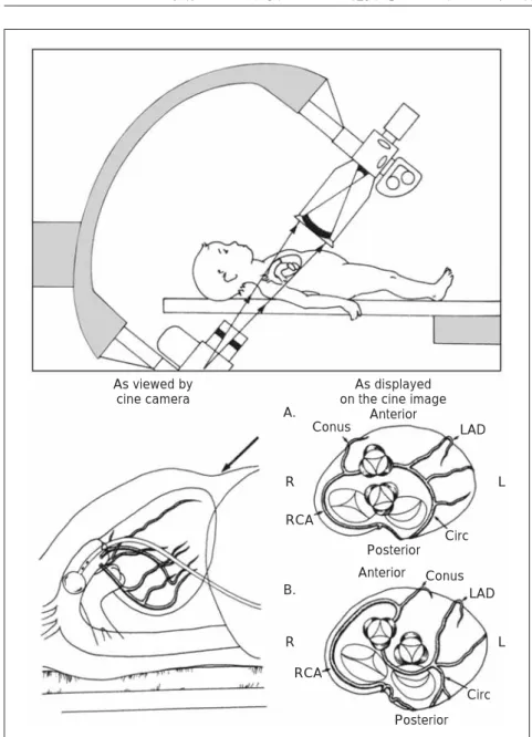 Fig. 10 Laid-back  aortogram.  Upper panel: Position of frontal C-arm with extreme caudal angulation of the tube. Lower left panel: Heart and balloon position as viewed by lateral image intensifier. Solid arrow in right upper corner shows viewpoint of fron