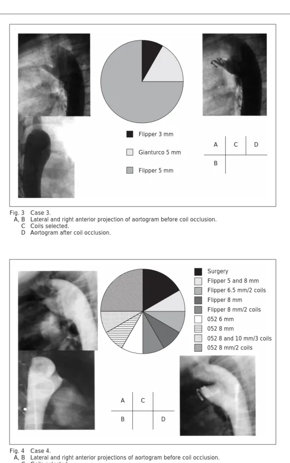 Fig. 3 Case 3. A, B Lateral and right anterior projection of aortogram before coil occlusion