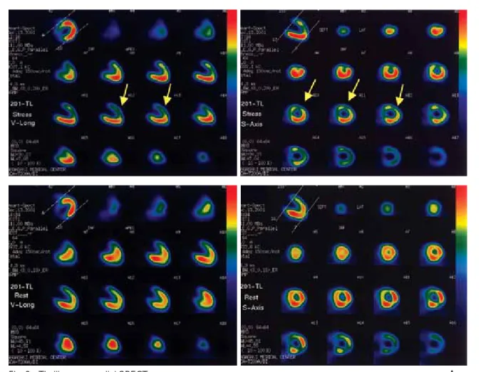 Fig. 2 Thallium myocardial SPECT.  Ischemic change was detectable in the anterior wall and ventricular septum at exercise but disap-peared on reperfusion