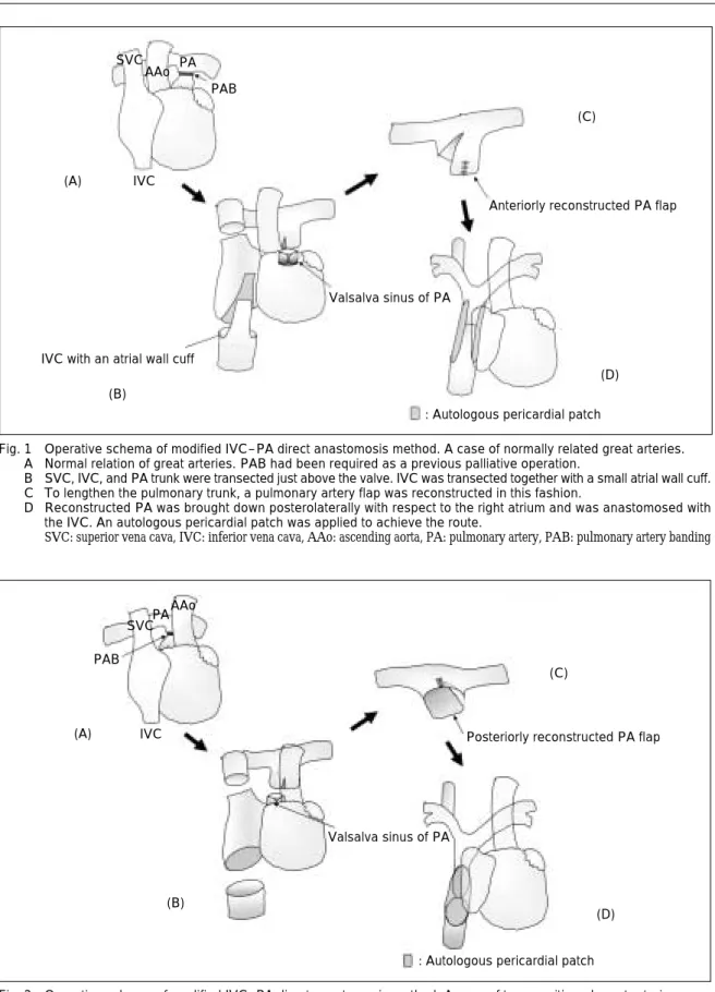 Fig. 2 Operative schema of modified IVC–PA direct anastomosis method. A case of transpositioned great arteries