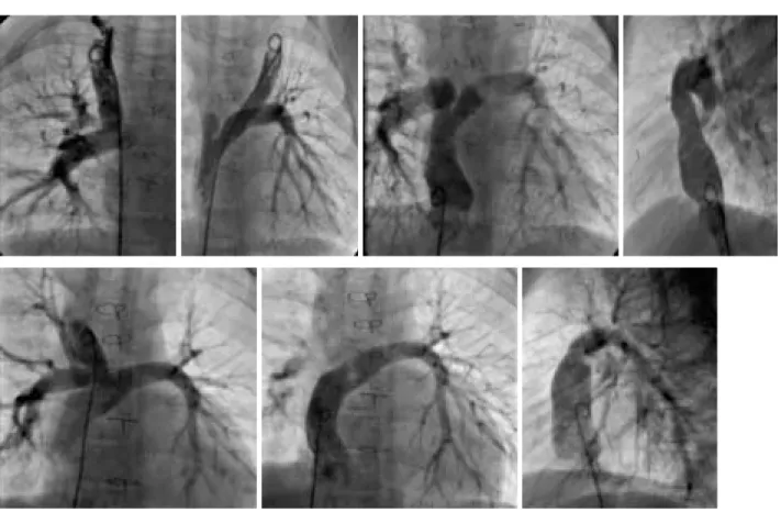 Fig. 3 Postoperative angiograms in case 1 (A) and case 3 (B). In both cases, images demonstrate the non-obstructive systemic venous pathway