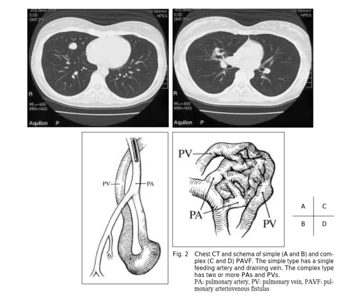 Fig. 2 Chest CT and schema of simple (A and B) and com- Chest CT and schema of simple (A and B) and com-plex (C and D) PAVF. The simple type has a single feeding artery and draining vein. The complex type has two or more PAs and PVs