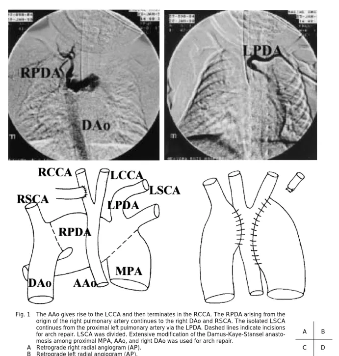Fig. 1 The AAo gives rise to the LCCA and then terminates in the RCCA. The RPDA arising from the origin of the right pulmonary artery continues to the right DAo and RSCA. The isolated LSCA continues from the proximal left pulmonary artery via the LPDA. Das