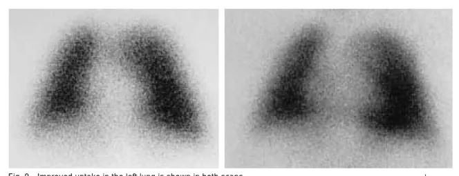 Fig. 9 Improved uptake in the left lung is shown in both scans. A Perfusion scan ( 99m Tc-MAA)