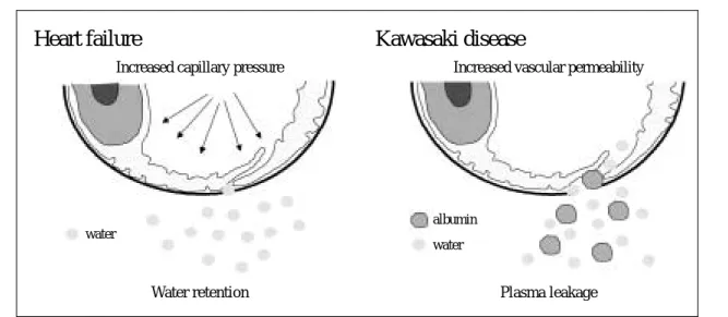 Fig. 1 Physiological mechanisms of edema in congestive heart failure and Kawasaki disease.