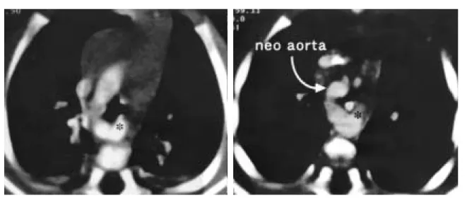 Fig. 2 Chest CT in case 7 showing tracheal compression by neoaorta and Kommerell’s diverticulum (＊)