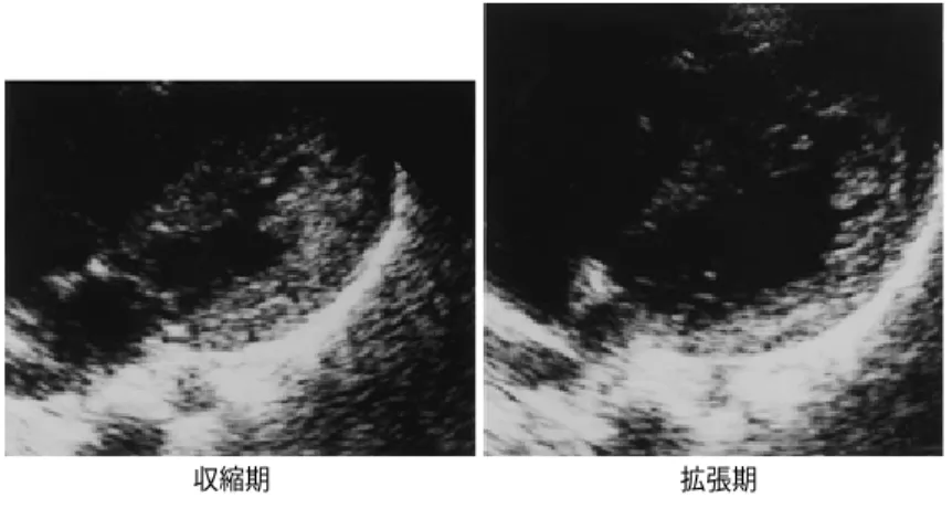 図 6 自験例妹の心エコー所見（四腔断面像）