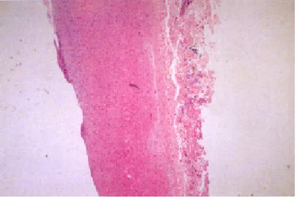 図 2 バルーン拡大後再狭窄症例の瘤部分