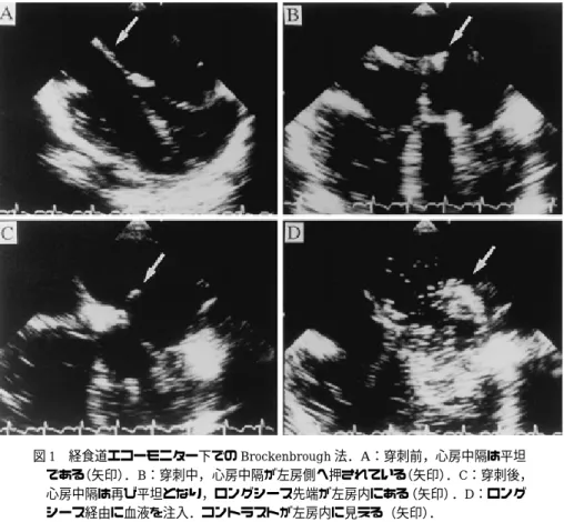 図 1 経食道エコーモニター下での Brockenbrough 法．A：穿刺前，心房中隔は平坦 である （矢印） ．B：穿刺中，心房中隔が左房側へ押されている （矢印） ．C：穿刺後， 心房中隔は再び平坦となり，ロングシース先端が左房内にある（矢印）．D：ロング シース経由に血液を注入．コントラストが左房内に見える（矢印） ． 図 2 A：症例 2 の左室造影側面像．B：7 F のロングシースを左房に挿入し，0.035" ガイドワイヤーを左室に留置し，Ultrathin バルーンカテーテルを僧帽弁に