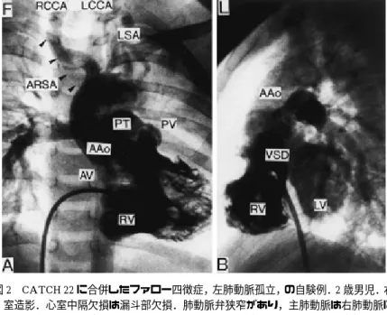 図 3 図 2 と同じ症例．大動脈弓の下側に動脈管の閉じた後の出っ張りがある．この造 影は肺動脈閉鎖に合併する動脈管開存の造影用のカテーテル 16） で造影した．略語．
