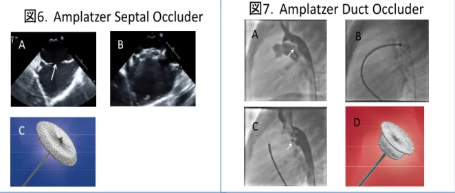 図 6 ． Amplatzer Septal Occluder