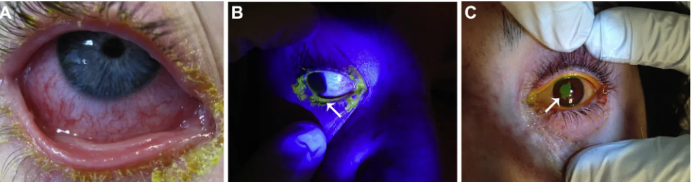 Figure 1. Ocular surface involvement in acute SJS/TEN. A. Conjunctival hyperemia and membrane