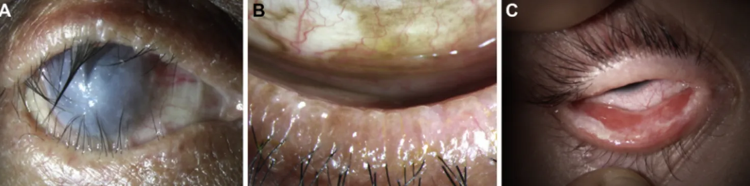Figure 5. Structural eyelid changes after SJS/TEN. A. Trichiasis from cicatricial entropion