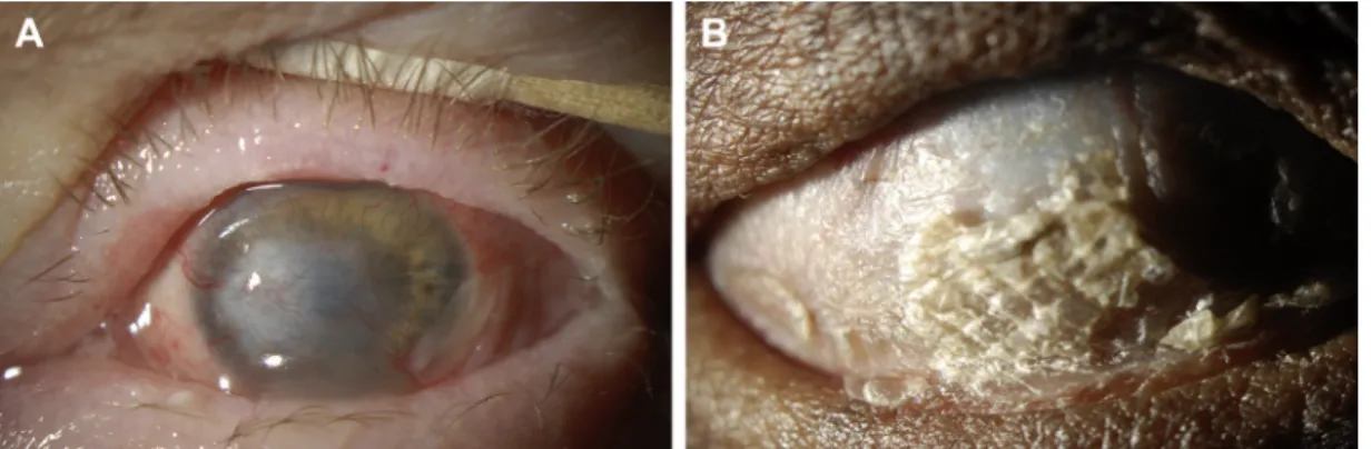Figure 12. Severe corneal sequelae of SJS/TEN. A. Dense corneal neovascularization and opacity in a wet, blinking eye