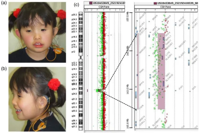 Fig. 1 (a and b): Frontal (a) and lateral (b) view of the proband. Permission was obtained from the parents for presentation
