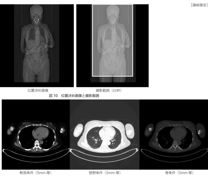 図 11 は全身 CT の再構成画像である。 再構成画像は横断像の 5mm であり、関数は軟部条 件と骨条件と肺野条件を出力する。 図 12 は内耳の再構成画像である。 内 耳 の 部 分 は 左 右 内 耳 の 横 断 像 0.5mm な い し 0.6mm と冠状断 1.0mm を作成。 図 13 は頸椎の再構成画像である。 頸椎については大後頭孔を含めた FOV で頸椎全域 の横断像 1mm と矢状断と冠状断 1mm であり関数は 骨条件を作成する。 図 14 は胸腰椎仙椎の再構成画像である。 胸腰椎