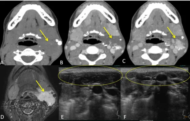 図 3. 30 歳代  女性  静脈奇形 Venous malformation 