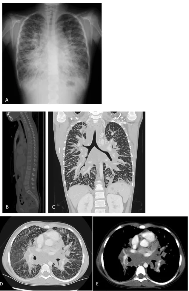 図 3： 10 歳  女児  Generalized lymphatic anomaly(GLA) 