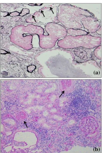 Fig. 7 Pathologic findings in the kidney in nephronophthisis patients.