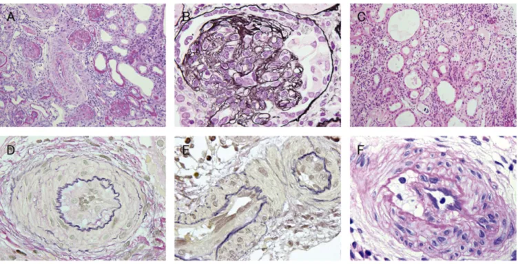Fig. 2 Histopathological ﬁndings of the kidney biopsy taken at day 37. (A) Almost all glomeruli had evidence of global sclerosis or were collapsed (periodic acid Schiff stain [PAS]; × 100)
