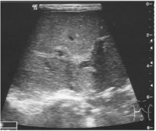 図 4-2  Triangular cord sign 