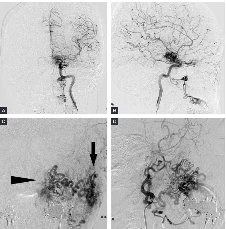 Fig. 1　Pre-treatment angiogram