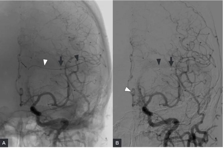 Fig. 4　 A：A microcatheter has been inserted into the left transverse sinus through a  4  Fr catheter