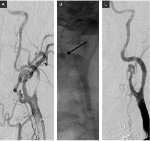 Fig. 2　Angiograms performed during the first carotid artery stenting  ( CAS ) .