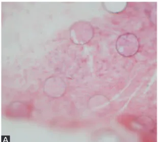 Fig. 5  Cellular lesions A： Pure  cellular  debris.  OM 