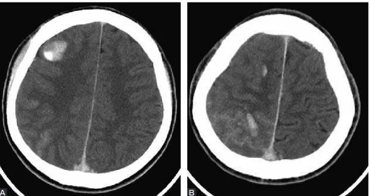 Fig. 5  Postoperative head CT scans show multiple intracerebral hematomas and subarachnoid hemorrhage  (A, B) .
