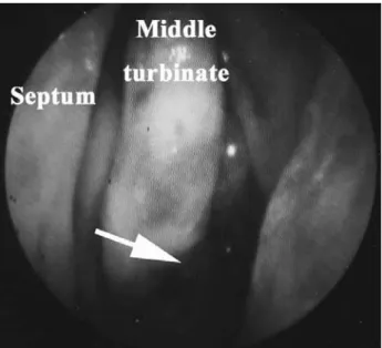 Fig. 1  Endoscopic  view  of  the  left  nasal  cavity.  The  white arrow indicates the bleeding point.