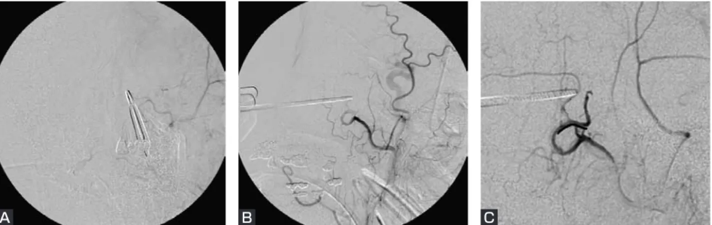 Fig. 4  Post-procedural left external carotid angiograms  (A：A - P view, B： 