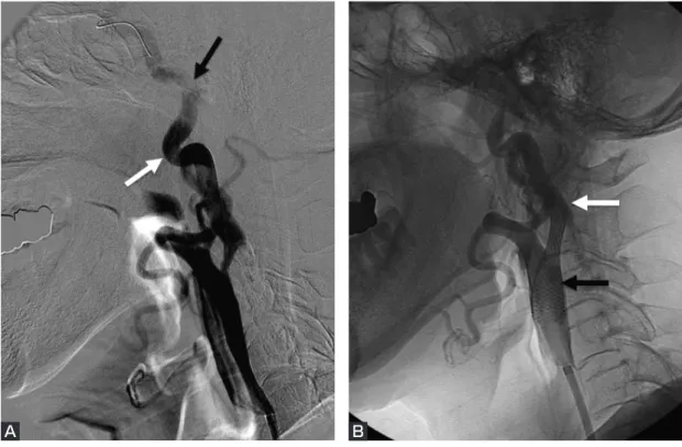Fig. 2 A carotid artery angiogram (lateral view) shows (A) the position of the FilterWire EZ (black arrow)  and tortuous internal carotid artery (white arrow) and (B) the carotid artery stent (black arrow). The  stent does not fit the internal carotid arte