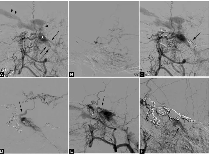 Fig. 1   Case  2　Angiograms  (lateral  views)  of  second  session  of  transvenous  embolization  for  dural  arterio-venous  (A-V)  fistula at the cavernous sinus (CS)