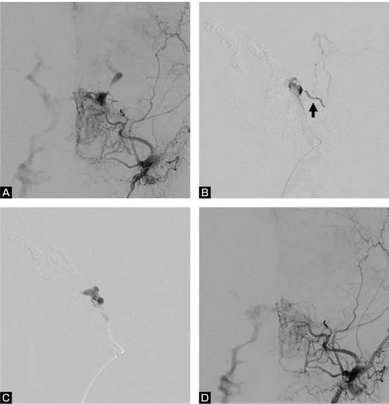 Fig. 2    Left external carotid angiogram (anteroposterior view) before 2nd transvenous embolization  (A)  showing  a  residual  shunt  in  the  left  cavernous  sinus  draining  into  the  bilateral  SOV,  SSV and right IPS