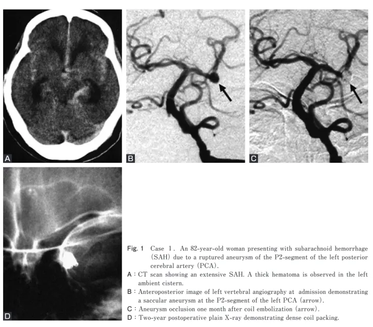 Fig. 1　 Case  １．An 82-year-old woman presenting with subarachnoid hemorrhage  (SAH) due to a ruptured aneurysm of the P2-segment of the left posterior  cerebral artery (PCA).