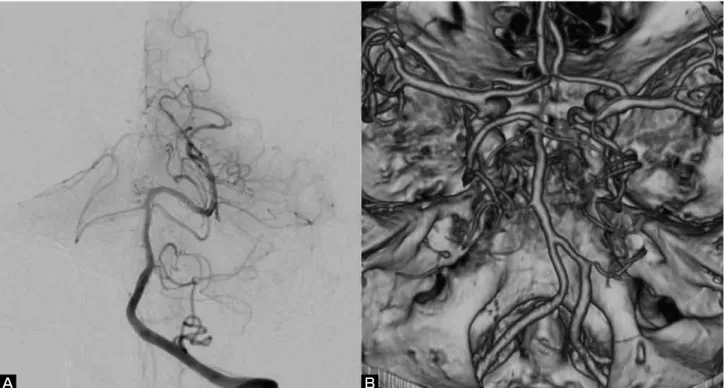 Fig. 3    Preoperative left vertebral angiography (A) and 3D-CTA (B) do not show any aneurysms in the posterior circulation