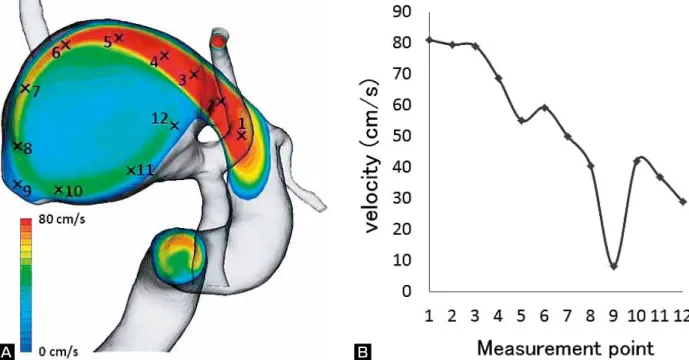 Fig. 2  Computerized flow dynamic analysis of the aneurysm. Velocity distribution in the plane including the parent artery  and the bleb is visualized in colored contour and overlaid on the transparent view of 3D-RA, lateral view (A)