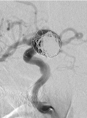 Fig. 4  Angiographic image immediately after the interventional  procedure.