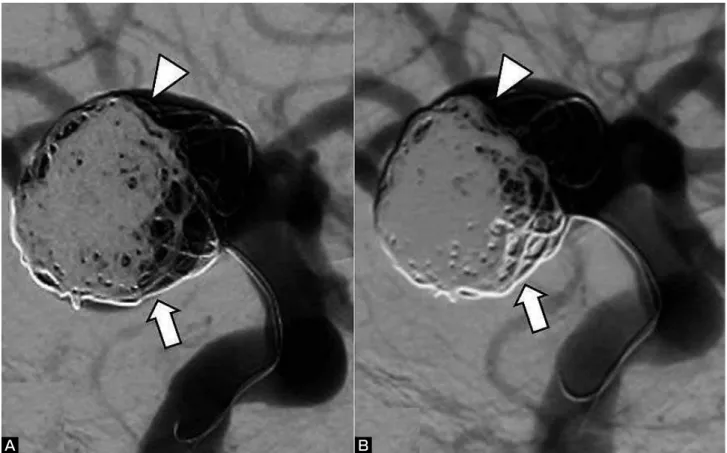 Fig. 5  Right  internal  carotid  angiograms  (lateral  views)  immediately  after  the  embolization  (A)  and  two  weeks  after  the  embolization (B)