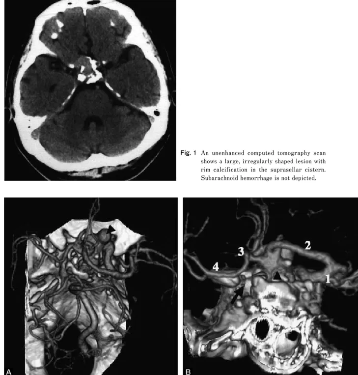 Fig. 2    Three-dimensional  computed  tomography  angiography, A：superior  view  shows  an  irregularly  shaped  aneurysm  of  the  anterior  communicating  artery  (arrowhead)  B：Posteroanterior  view